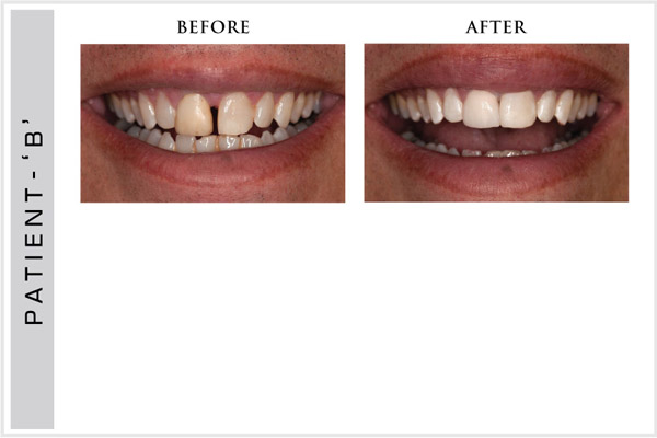 Smile Design, Sensura Dental