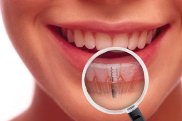 Dental Implants