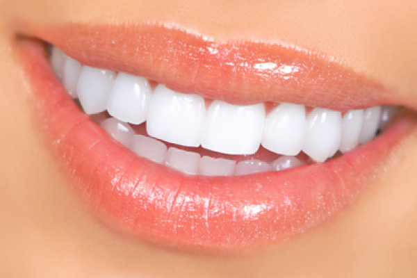 Dental Veneers