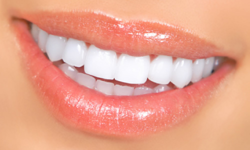 Dental Veneers