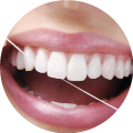 Dental Veneers